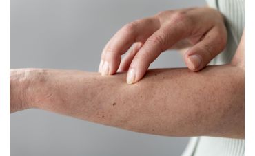 Nos conseils pour soulager l’eczéma de façon naturelle